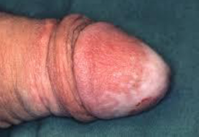 Lichen sclerosus